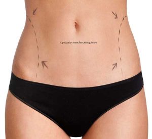 Liposuction liposakşın